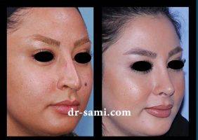 جراحی زیبایی بینی