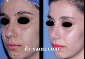جراحی بینی گوشتی به شکل طبیعی