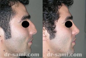 سن جراحی بینی | عمل بینی مردانه