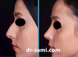 جراحی زیبایی بینی