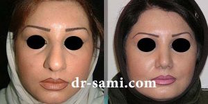 رینوپلاستی بینی گوشتی