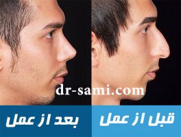 جراحی زیبایی بینی