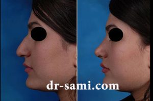 عمل زیبایی بینی و رفع قوز بینی