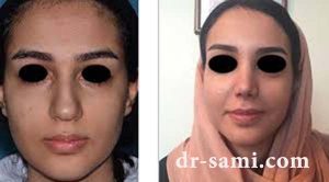 کوچک کردن سایز بینی متناسب با صورت
