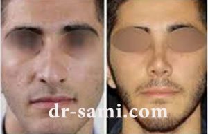 عمل زیبایی بینی