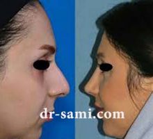 جراحی زیبایی بینی متناسب با فرم صورت