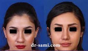جراحی بینی رینوپلاستی