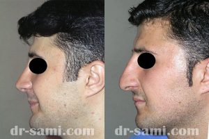 جراحی زیبایی بینی توسط دکتر سامی