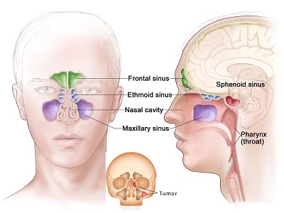 تومور سینوس و بینی