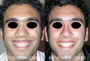 عمل بینی گوشتی مردانه همراه با اصلاح لبخند لثه‌ای - دکتر سامی