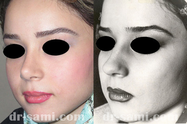 عکس قبل و بعد از عمل ، جراحی زیبایی بینی | دکتر سامی