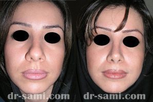 عمل بینی گوشتی خیلی بزرگ- دکتر سامی | قبل و بعد عمل بینی گوشتی | عکس بینی گوشتی با پوست ضخیم 