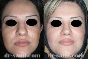 عمل بینی گوشتی | عکس بینی گوشتی با پوست ضخیم |دکتر سامی