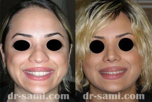 قبل و بعد عمل بینی گوشتی | دکتر سامی