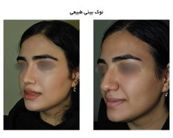 فرم طبیعی نوک بینی در جراحی بینی طبیعی