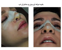 نحوه ایجاد برش و بخیه حرفهای در جراحی بینی طبیعی