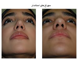 سوراخهای بینی استاندارد در بینی طبیعی