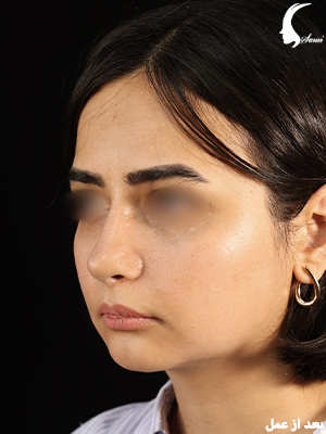 عمل بینی گوشتی شدیدا پروجکشن بعد از عمل به همراه لیفت لب | دکتر شاهین فتح سامی