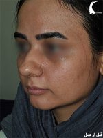 عمل بینی گوشتی پروجکشن زنانه قبل از عمل | دکتر شاهین فتح سامی