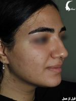 جراحی زیبایی بینی | برطرف کردن قوز بینی و کوتاه کردن مناسب | دکتر سامی