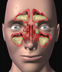 علائم شکستگی بینی - دکتر سامی