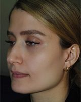 نمونه کار جراحی بینی به سبک نیمه فانتزی دکتر سامی - نمونه 1 قبل از عمل