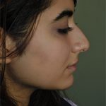 نمونه کار جراحی بینی به سبک نیمه فانتزی دکتر سامی - نمونه 2 قبل از عمل