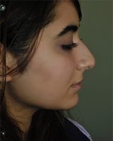 نمونه کار جراحی بینی به سبک نیمه فانتزی دکتر سامی - نمونه 2 قبل از عمل
