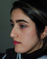 نمونه کار جراحی بینی به سبک نیمه فانتزی دکتر سامی - نمونه 3 قبل از عمل