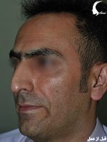 عمل بینی طبیعی مردانه قبل از عمل