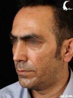 عمل بینی طبیعی مردانه بعد از عمل