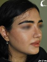 عمل بینی زنانه بعد از عمل