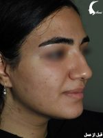 عمل بینی زنانه قبل از عمل