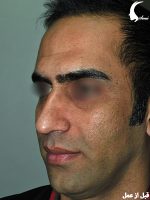 عمل بینی مردانه قبل از عمل