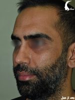 عمل بینی مردانه بعد از عمل