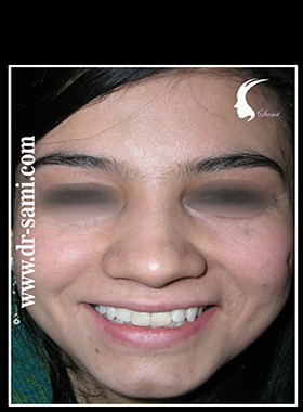 بهترین جراح بینی گوشتی دکتر سامی با تجربه در جراحی بینی با نوک پهن و پوست ضخیم