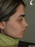 عمل بینی گوشتی بزرگ به همراه لیفت لب- دکتر سامی جراح