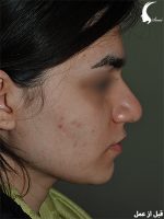 عمل بینی گوشتی به همراه لیفت لب- دکتر سامی